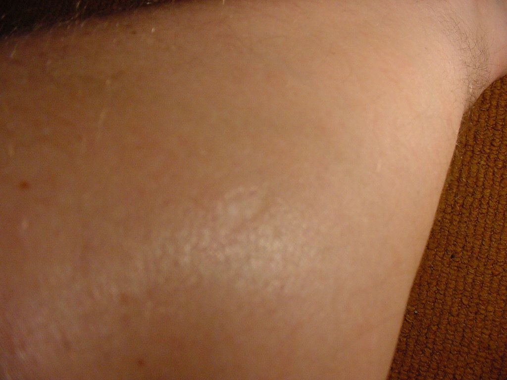 Fig. #N3b: scar on the leg from UFO implant